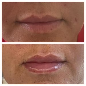 before and after lip fillers aesthetic treatment