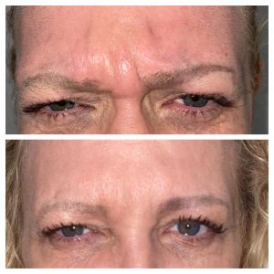 before and after botox aesthetic treatment