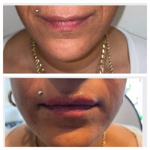 before and after lip fillers aesthetic treatment